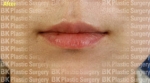 BK Plastic Surgery, Reviews, Images, Promotions — Korea cost, reviews & before-after | MISOODA