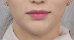 ID Plastic Surgery , Reviews, Images, Promotions — Korea cost, reviews & before-after | MISOODA