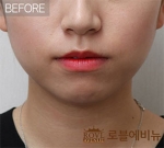 Rovl Avenue Liposuction,Reviews,Images, Promotions — Korea cost, reviews & before-after | MISOODA