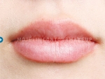 Mojelin Hair Transplant,Reviews,Images, Promotions — Korea cost, reviews & before-after | MISOODA