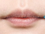 Mojelin Hair Transplant,Reviews,Images, Promotions — Korea cost, reviews & before-after | MISOODA