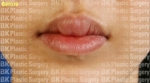 BK Plastic Surgery, Reviews, Images, Promotions — Korea cost, reviews & before-after | MISOODA