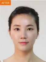 Banobagi Plastic Surgery,Reviews,Images, Promotions, MISOODA — Korea cost, reviews & before-after | MISOODA