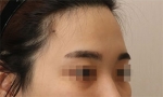 Rovl Avenue Liposuction,Reviews,Images, Promotions — Korea cost, reviews & before-after | MISOODA