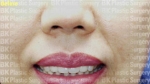 BK Plastic Surgery, Reviews, Images, Promotions — Korea cost, reviews & before-after | MISOODA