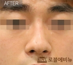 Rovl Avenue Liposuction,Reviews,Images, Promotions — Korea cost, reviews & before-after | MISOODA
