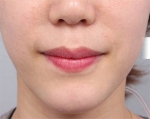 DA Plastic Surgery, Reviews, Images, Promotions — Korea cost, reviews & before-after | MISOODA