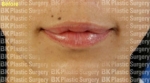 BK Plastic Surgery, Reviews, Images, Promotions — Korea cost, reviews & before-after | MISOODA