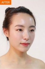 Banobagi Plastic Surgery,Reviews,Images, Promotions, MISOODA — Korea cost, reviews & before-after | MISOODA