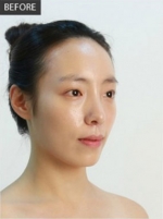 Banobagi Plastic Surgery,Reviews,Images, Promotions, MISOODA — Korea cost, reviews & before-after | MISOODA