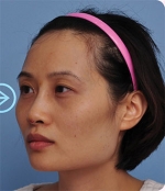 The Plastic Surgery, Reviews,Images, Promotions, — Korea cost, reviews & before-after | MISOODA