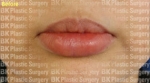 BK Plastic Surgery, Reviews, Images, Promotions — Korea cost, reviews & before-after | MISOODA
