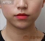 Rovl Avenue Liposuction,Reviews,Images, Promotions — Korea cost, reviews & before-after | MISOODA
