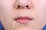 Deesse Plastic Surgery, Reviews,Images, Promotions — Korea cost, reviews & before-after | MISOODA
