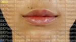 BK Plastic Surgery, Reviews, Images, Promotions — Korea cost, reviews & before-after | MISOODA