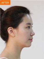 Banobagi Plastic Surgery,Reviews,Images, Promotions, MISOODA — Korea cost, reviews & before-after | MISOODA