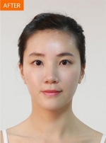 Banobagi Plastic Surgery,Reviews,Images, Promotions, MISOODA — Korea cost, reviews & before-after | MISOODA
