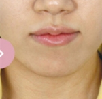 Banobagi Plastic Surgery,Reviews,Images, Promotions, MISOODA — Korea cost, reviews & before-after | MISOODA