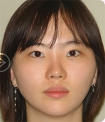 The Plastic Surgery, Reviews,Images, Promotions, — Korea cost, reviews & before-after | MISOODA