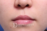 Deesse Plastic Surgery, Reviews,Images, Promotions — Korea cost, reviews & before-after | MISOODA