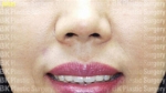 BK Plastic Surgery, Reviews, Images, Promotions — Korea cost, reviews & before-after | MISOODA