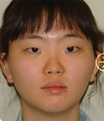 The Plastic Surgery, Reviews,Images, Promotions, — Korea cost, reviews & before-after | MISOODA