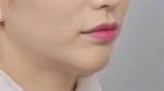 ID Plastic Surgery , Reviews, Images, Promotions — Korea cost, reviews & before-after | MISOODA