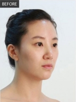 Banobagi Plastic Surgery,Reviews,Images, Promotions, MISOODA — Korea cost, reviews & before-after | MISOODA