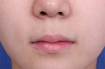 Deesse Plastic Surgery, Reviews,Images, Promotions — Korea cost, reviews & before-after | MISOODA