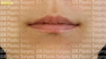 BK Plastic Surgery, Reviews, Images, Promotions — Korea cost, reviews & before-after | MISOODA