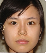 The Plastic Surgery, Reviews,Images, Promotions, — Korea cost, reviews & before-after | MISOODA