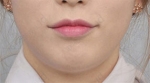 ID Plastic Surgery , Reviews, Images, Promotions — Korea cost, reviews & before-after | MISOODA