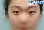 Jewelry Plastic Surgery,Reviews,Images, Promotions — Korea cost, reviews & before-after | MISOODA