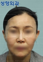 Jewelry Plastic Surgery,Reviews,Images, Promotions — Korea cost, reviews & before-after | MISOODA