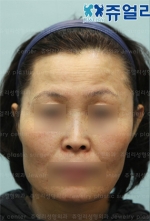 Jewelry Plastic Surgery,Reviews,Images, Promotions — Korea cost, reviews & before-after | MISOODA