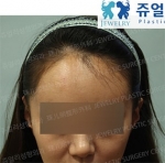 Jewelry Plastic Surgery,Reviews,Images, Promotions — Korea cost, reviews & before-after | MISOODA
