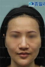 Jewelry Plastic Surgery,Reviews,Images, Promotions — Korea cost, reviews & before-after | MISOODA