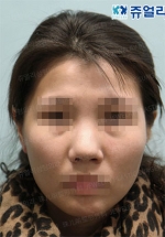 Jewelry Plastic Surgery,Reviews,Images, Promotions — Korea cost, reviews & before-after | MISOODA