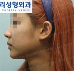 Jewelry Plastic Surgery,Reviews,Images, Promotions — Korea cost, reviews & before-after | MISOODA