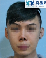 Jewelry Plastic Surgery,Reviews,Images, Promotions — Korea cost, reviews & before-after | MISOODA