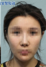 Jewelry Plastic Surgery,Reviews,Images, Promotions — Korea cost, reviews & before-after | MISOODA