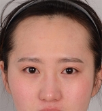 hairline