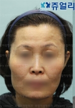Jewelry Plastic Surgery,Reviews,Images, Promotions — Korea cost, reviews & before-after | MISOODA