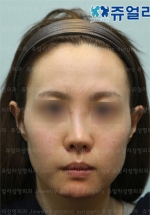 Jewelry Plastic Surgery,Reviews,Images, Promotions — Korea cost, reviews & before-after | MISOODA