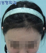 Jewelry Plastic Surgery,Reviews,Images, Promotions — Korea cost, reviews & before-after | MISOODA
