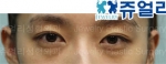 Jewelry Plastic Surgery,Reviews,Images, Promotions — Korea cost, reviews & before-after | MISOODA
