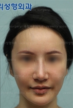 Jewelry Plastic Surgery,Reviews,Images, Promotions — Korea cost, reviews & before-after | MISOODA