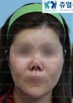 Jewelry Plastic Surgery,Reviews,Images, Promotions — Korea cost, reviews & before-after | MISOODA