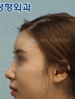 Jewelry Plastic Surgery,Reviews,Images, Promotions — Korea cost, reviews & before-after | MISOODA
