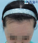Jewelry Plastic Surgery,Reviews,Images, Promotions — Korea cost, reviews & before-after | MISOODA